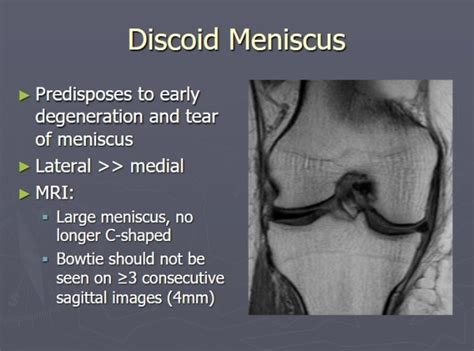 원판형 반월상 연골(Discoid meniscus) : 어린 아이가 무릎 통증과 탄발음을 호소해요 : 네이버 블로그