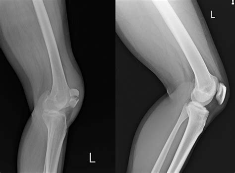 Xray Left Knee Lateral Showing Kneecap Fracture And Normal Stock Photo - Download Image Now - iStock