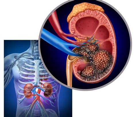 * An Overview of Kidney Cancer - symptoms, causes and treatment alternatives | CANCERactive