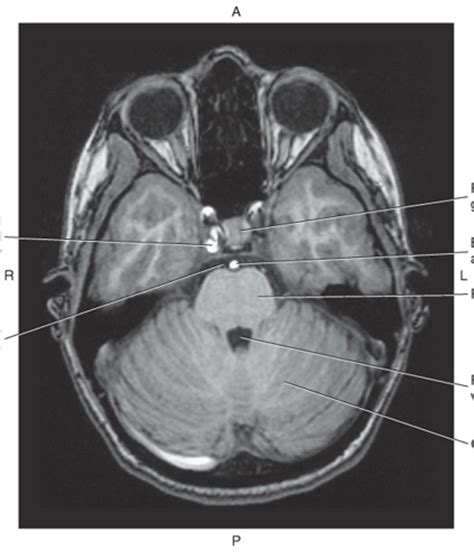 MRI pons Diagram | Quizlet