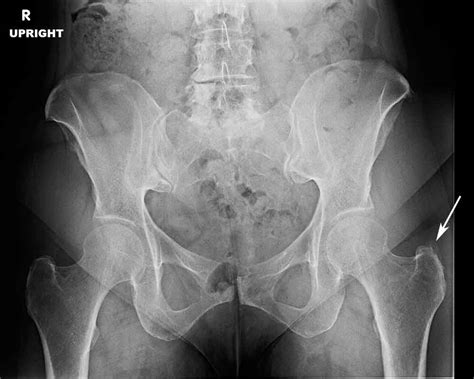 Greater Trochanteric Bursitis | Spine Specialist