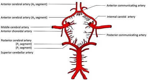 Duplicated Anterior Choroidal Arteries: Literature Review and Clinical Implications | Cureus