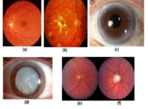 Various type of ocular diseases | Download Scientific Diagram