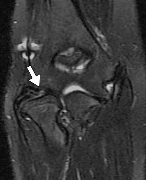 MRI of the Annular Ligament of the Elbow: Review of Anatomic Considerations and Pathologic ...