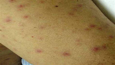 Typhus: Causes, Symptoms, and Diagnosis