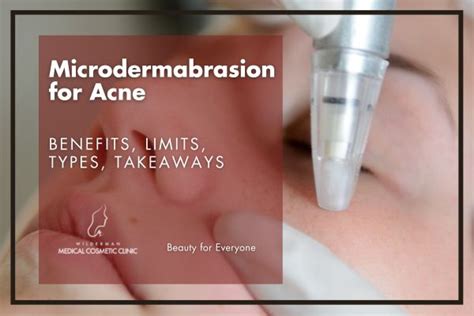 Microdermabrasion for Acne | Wilderman Cosmetic Clinic