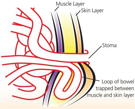 Hernia Information - Ostomy Care & Supply