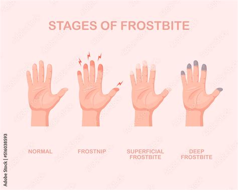 Frozen hands with fingers. Stage of frostbite. Skin burn symptom. Vector illustration isolated ...