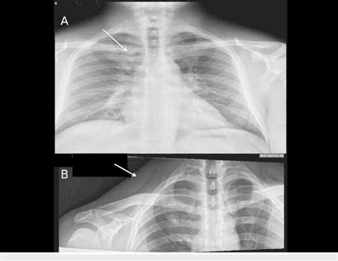 Chest X-ray AP view and right clavicle X-ray AP view. A: Chest X-ray AP... | Download Scientific ...