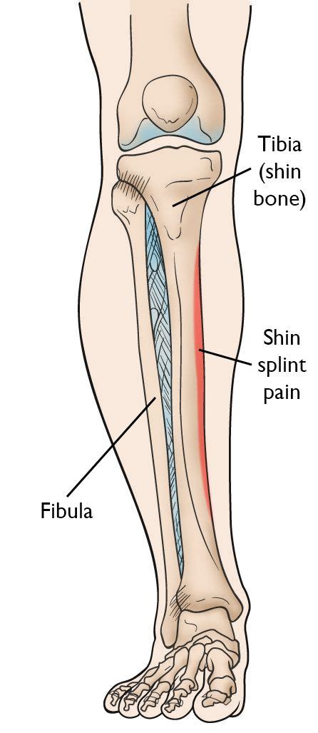 Shin Splints - OrthoInfo - AAOS