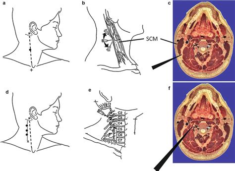 Cervical Plexus Injection