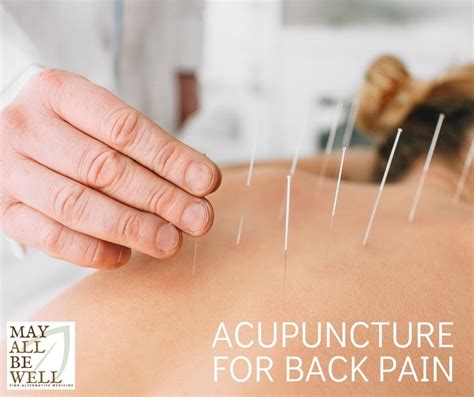 Acupuncture for Back Pain - Does It Work? | May All Be Well