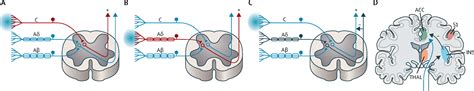 Allodynia and hyperalgesia in neuropathic pain: clinical manifestations and mechanisms - The ...