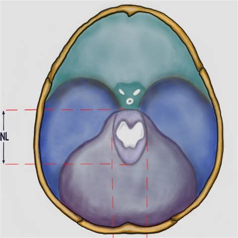 Individual variation of tentorial notch morphometry in a series of neurocritical patients ...