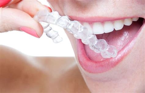 Invisalign Cleaner Solutions – Finding the Best Methods - Surf Oceanside