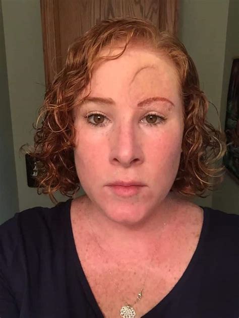 Mom Shares Photos Of How Melanoma Almost Ate Her Forehead | Elite Readers