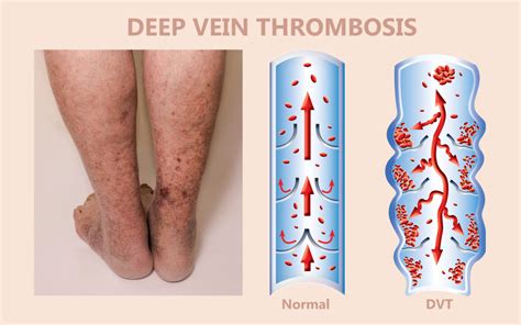 Understanding DVT and The Symptoms - Deep Vein Thrombosis