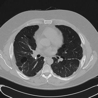 What is the role of a chest CT scan in the evaluation of pneumothorax?