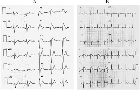 Commentary on the Brugada ECG Pattern | Circulation: Arrhythmia and Electrophysiology