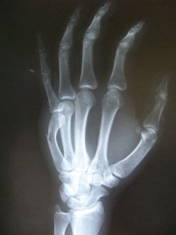 Hand Fractures & Hand Fracture Surgery - Michigan Surgery Specialists