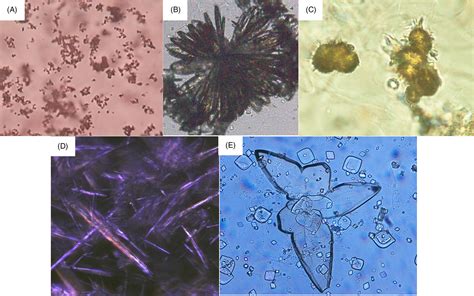 Amorphous Phosphate Crystals In Urine