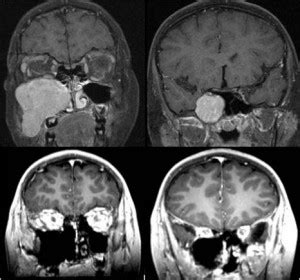 Nasal and Sinus Tumors – BeverlyHillsENT