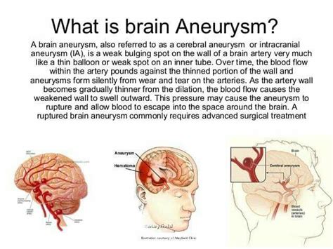 What is an aneurysm ? | Brain aneurysm, Aneurysm, Brain aneurysm survivor