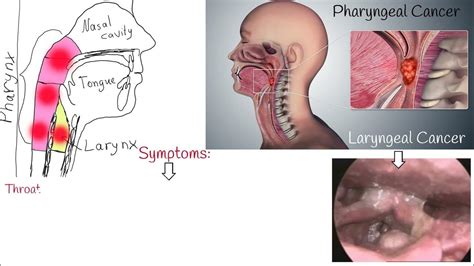 Throat cancer - Symptoms, causes and Treatment. Laryngeal Cancer and Pharyngeal Cancer - YouTube