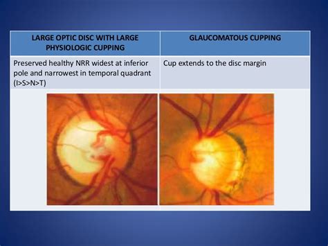 Optic disc evaluation