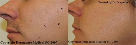 Sebaceous hyperplasia removal with radiofrequency surgery in New York