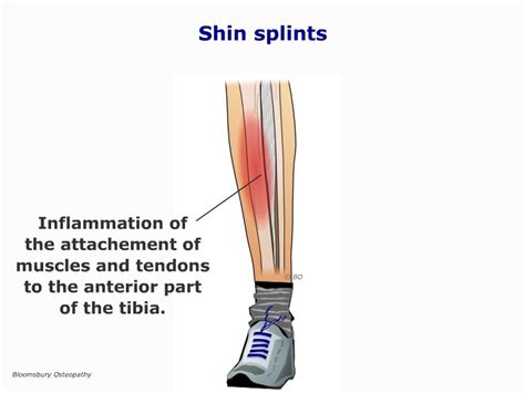 Shin Splints LEGP08 - Bloomsbury Health Centre