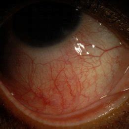 Funds photograph demonstrating severe retinal vasculitis. Significant... | Download Scientific ...