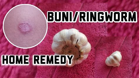 Gamot sa Buni/Ringworm | Home Remedy | Ka-khie tv - YouTube