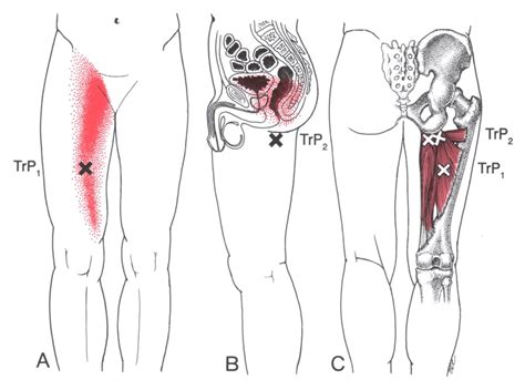 Pin on Health Myofascial Release Trigger Point