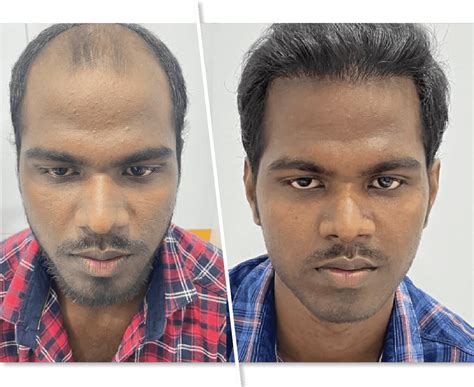 Hair Re-Growth & Hair fall Treatment in Hyderabad: Kolors