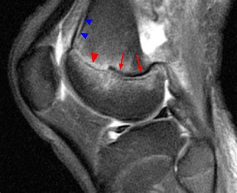 Salter-Harris Fractures - Radsource