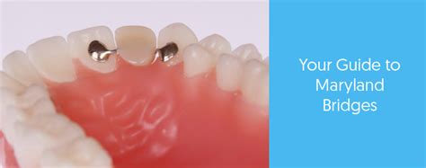 What is a Maryland Bridge and Do I Need One? - Dental Aware Australia