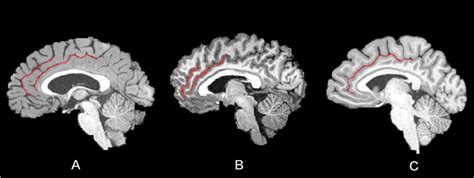 The variations in the paracingulate sulcus (PCS) and the cingulate... | Download Scientific Diagram