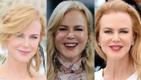 Nicole Kidman Plastic Surgery Before and After Pictures 2024