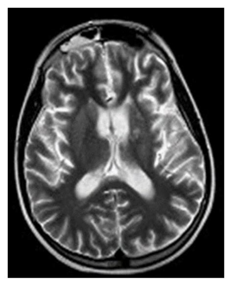 T2-weighted images reveal hyperintense lesions over the left internal... | Download Scientific ...