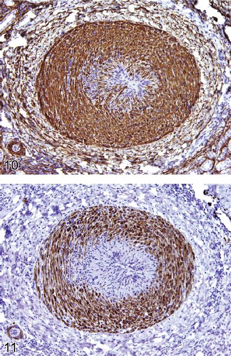 —Immunohistochemistry for alpha-smooth muscle actin in an eosinophilic ...