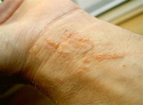 Poison Ivy Rash - Pictures, Causes, Treatment, Contagious