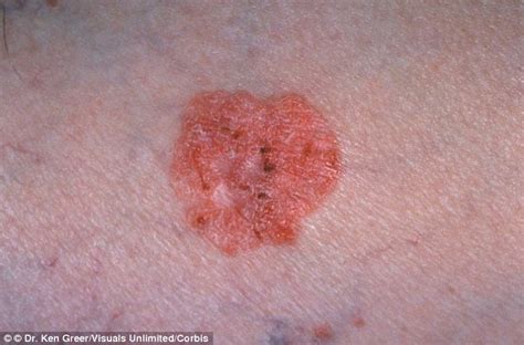 Revealed... how to tell if you have skin cancer: From bleeding, itchy moles to flat, red spots ...