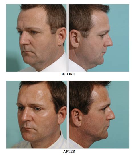 Male Facelift Los Angeles, Male Plastic Surgery Beverly Hills