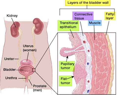 Transitional cell carcinoma causes, symptoms, diagnosis, treatment & prognosis