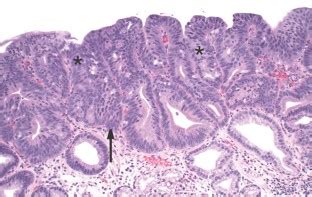 Barrett esophagus: histology and pathology for the clinician | Nature ...