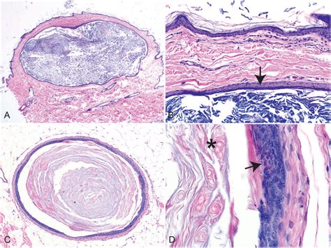 Follicular Cyst