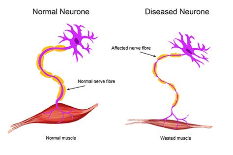 Ayurvedic Treatment for Motor Neurone Disease (MND) - Planet Ayurveda