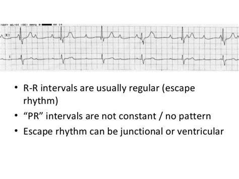 ECG Lecture: Sinus arrest, sinoatrial exit block, AV block and escape…