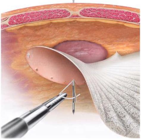 Laparoscopic Hernia Surgery